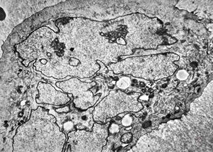 F,16y. | bone marrow - malignant histiocytosis F,16y. | bone marrow - malignant histiocytosis